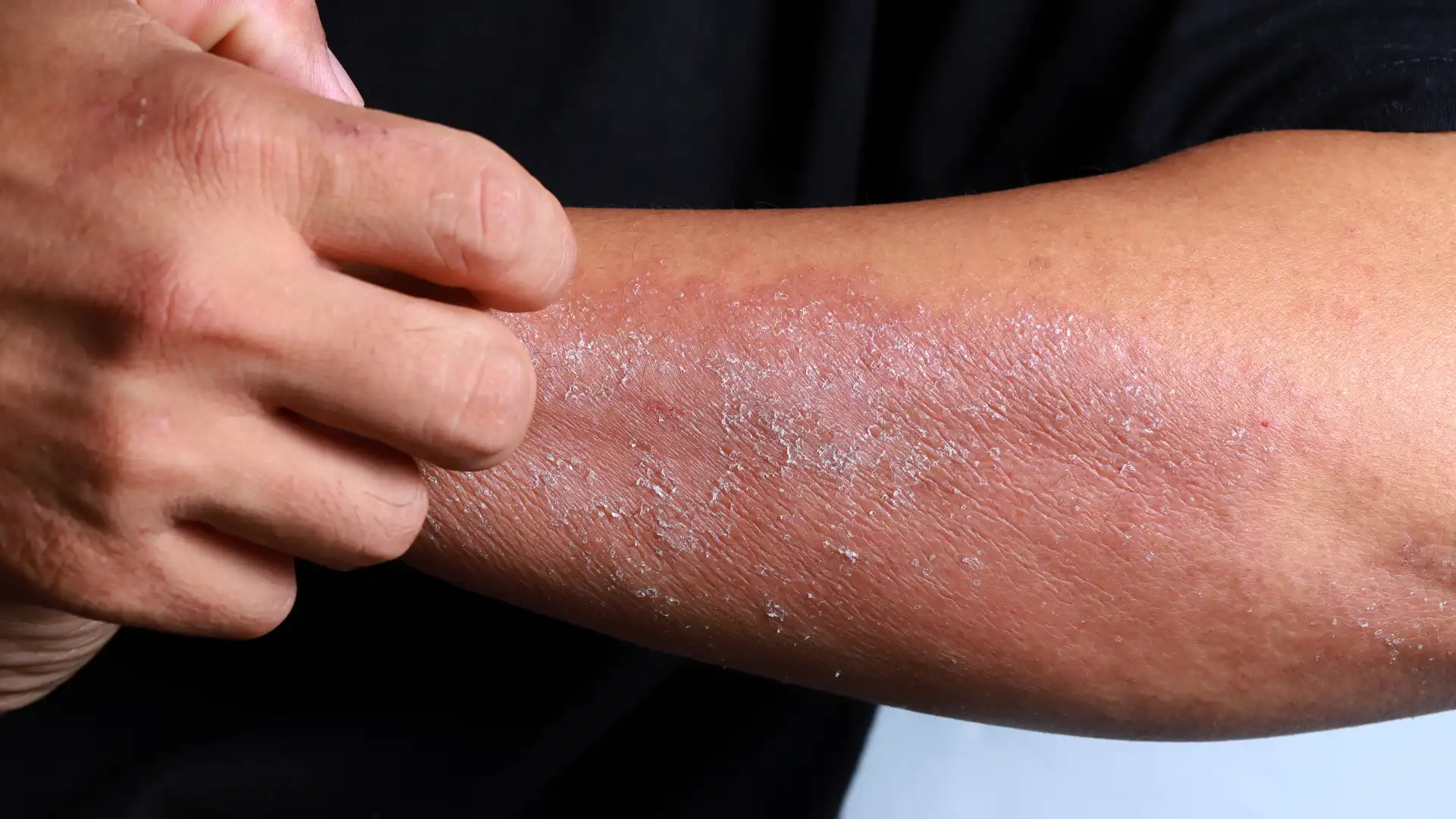 Skin Issues